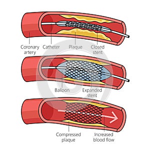 Diagram coronary stent placement medical science