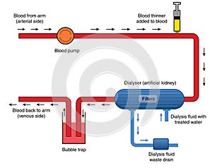 Diagram of kidney dialysis machine