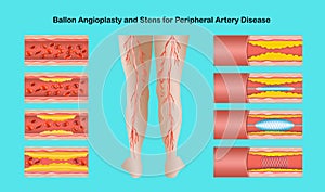 Diagram showing angioplasty for peripheral artery disease illustration