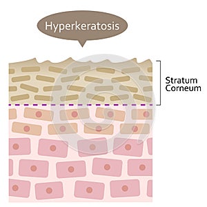 Diagram of skin cell turnover and thickening of the stratum corneum. Skin care and beauty concept