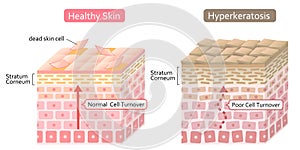 Diagram of skin cell turnover and thickening of the stratum corneum. Skin care and beauty concept