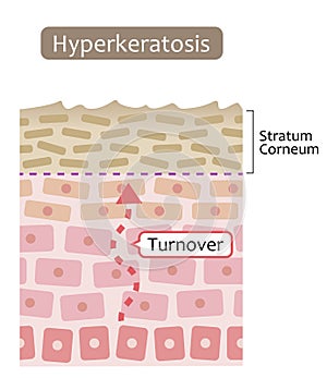 Diagram of skin cell turnover and thickening of the stratum corneum. Skin care and beauty concept