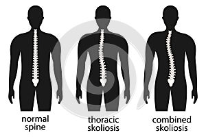Diagram with spine curvature and healthy spine.
