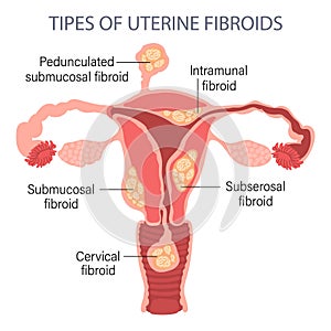 Diagram of types of uterine fibroids in a woman on a white background. Genicolgia. Medical concept. Infographic banner.