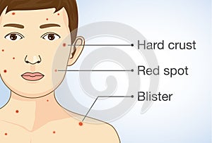 Diagram of the varicella infection in a child.