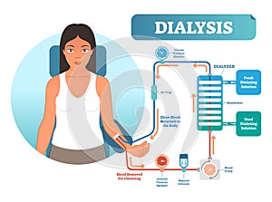 Dialysis medical procedure system vector illustration diagram. Filtering blood in case of kidney malfunction.