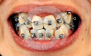 Diamond braces