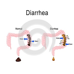 Diarrhea and dysentery