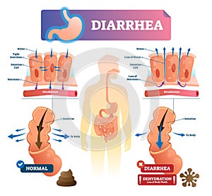 Diarrhea vector illustration. Labeled stomach gut illness medical scheme. photo