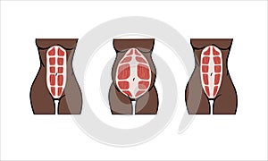 Different types of Diastasis
