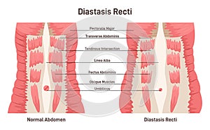 Diastasis rect. Abdominal muscles separation. Human torso muscles