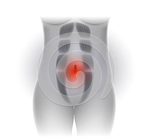 Diastasis Recti or abdominal separation