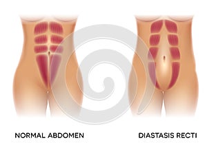 Diastasis recti