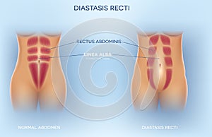 Diastasis Recti photo