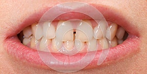 Diastema between the upper incisors