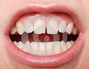 Diastema between the upper incisors