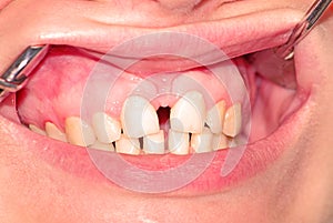 Diastema of the upper jaw