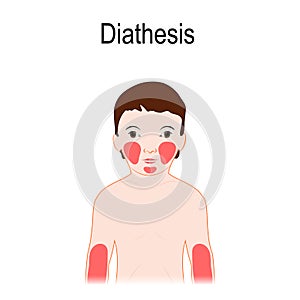 Diathesis. Atopic dermatitis atopic eczema. Location on a huma