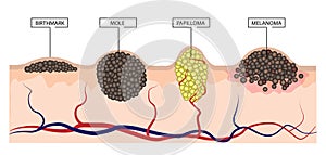 The difference between a birthmark, mole, papilloma and melanoma. Infographics