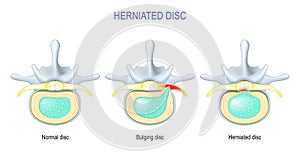 Difference Between Bulging disc and Herniated Disc