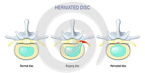 Difference Between Bulging disc and Herniated Disc photo