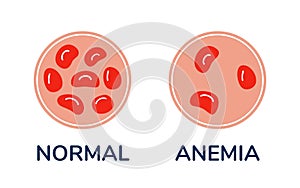 The difference comparison of a drop of blood with normal and anemic cells under microscope vector Medical illustration photo