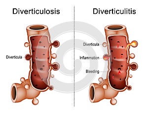 Difference between diverticulitis and diverticulosis