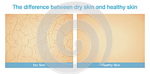 The difference between dry skin and healthy skin.