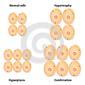 Difference hyperplasia, hypertrophy and normal cel photo