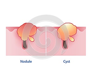 The difference between nodule and cystic acne vector isolated on white background.