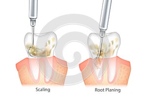 Difference of the Periodontal Scaling and Root Planing. Oral hygiene and conventional periodontal therapy. Human teeth