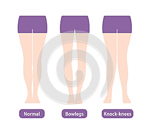 Difference types of legs angles and knees vector illustration . Normal, Bowlegs, Knock-knees.