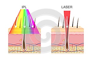 The difference of using IPL light and laser in hair removal.