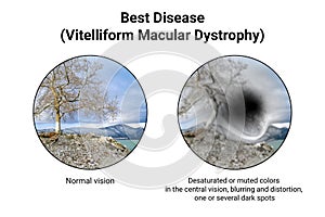 The difference between the vision of a normal eye and an eye affected by Best disease, illustration photo