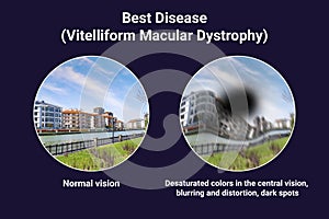 The difference between the vision of a normal eye and an eye affected by Best disease, illustration