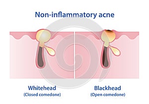 The difference between whitehead and blackhead acne vector illustration.