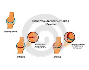 Differences arthrosis from arthritis