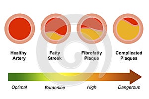 Differences of atherosclerosis stages