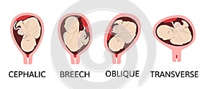 Different baby positions during pregnancy. Cephalic, Breech, transverse, Oblique lies. Colored medical vector illustration