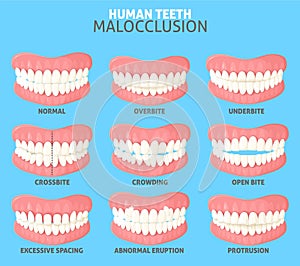 Different human teeth malocclusion types front view set photo