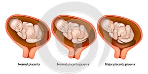 Different Placental Locations During Pregnancy