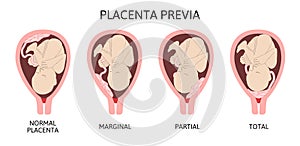 Different Placental Locations During Pregnancy. Major and Normal placenta previa, total and partial.