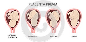 Different Placental Locations During Pregnancy. Major and Normal placenta previa, total and partial. photo