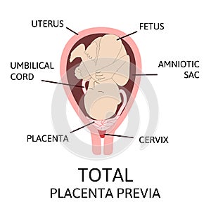 Different Placental Locations During Pregnancy. Major and Normal placenta previa, total and partial. photo