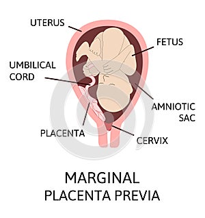 Different Placental Locations During Pregnancy. Major and Normal placenta previa, total and partial photo