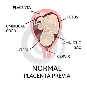Different Placental Locations During Pregnancy. Major and Normal placenta previa, total and partial photo