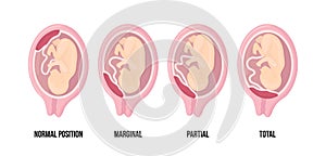 Different Placental Locations During Pregnancy. Normal, marginal, partial and total previa. photo