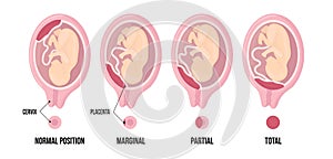 Different Placental Locations During Pregnancy. Normal, marginal, partial and total previa. photo