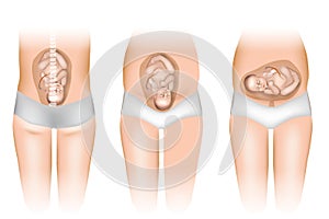 Different Positions of Baby in the Womb.