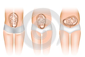 Different Positions of Baby in the Womb. photo